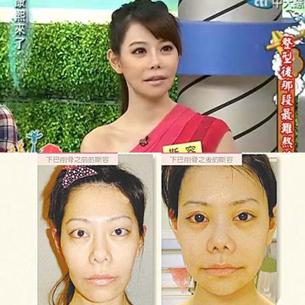 昆凌昔日综艺秀鼻塌脸肿似变脸 图揭明星整容失败僵脸