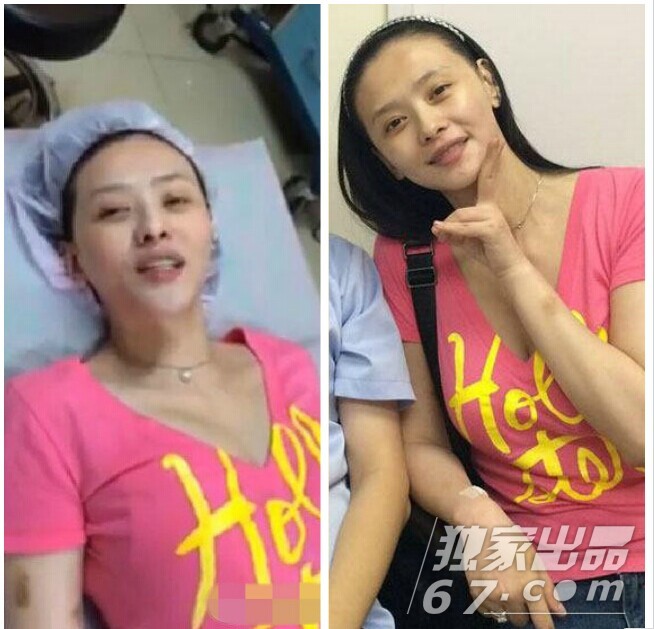 不少明星大胆承认自己整容的事实，来看下吧