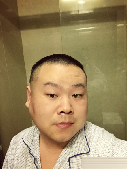 岳云鹏脸部良性瘤