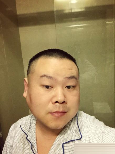 岳云鹏面部肿瘤切除手术成功 发微博报平安