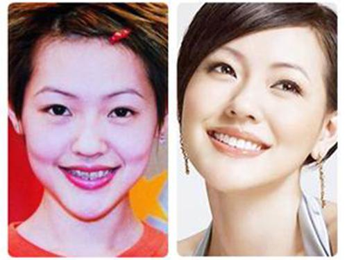 细数因牙齿变丑明星 女星几乎都整过牙
