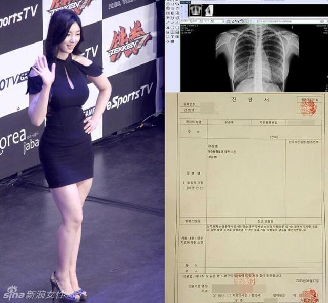 韩国美胸超模柳胜玉晒X光片力证未隆胸