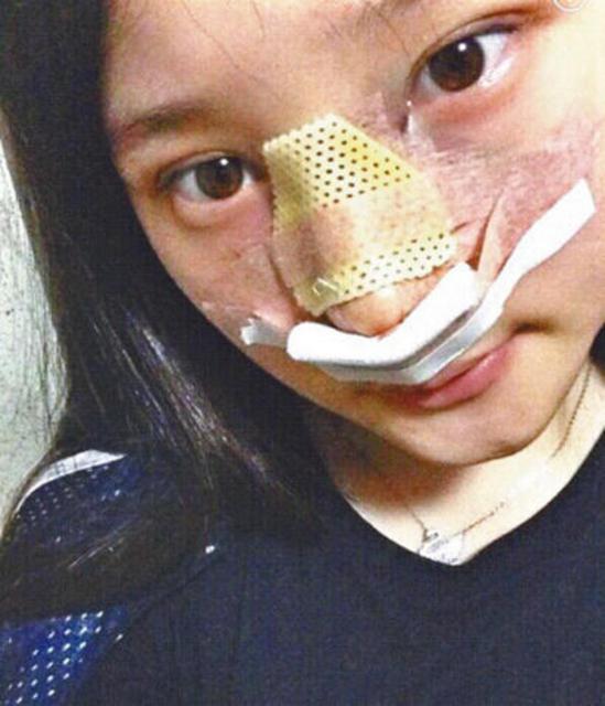 郑采妍整容期间的照片被曝光
